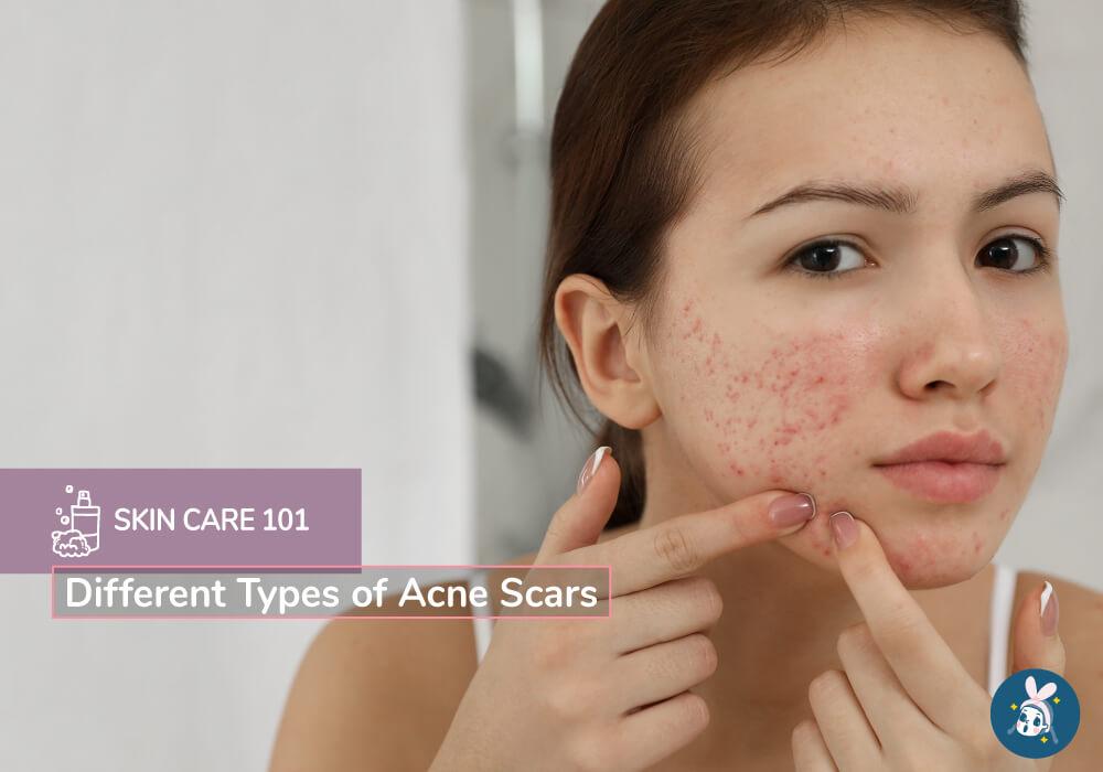 Different Types of Acne Scars